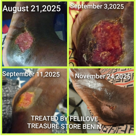 Diabetic Sore Gone Testimony